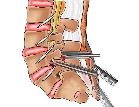جراحی کمر-دیسک کمر- بهترین درمان دیسک-پلاتین-عمل پلاتین-لغزندگی مهره-لیستزیس-عمل دیسک-عمل کمر-تنگی نخاع-پارگی دیسک-