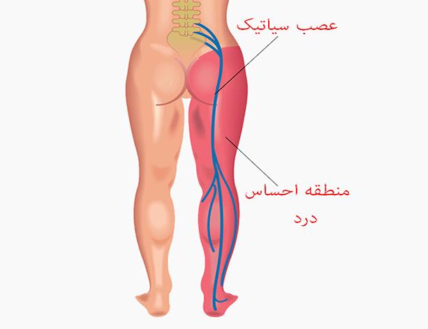 درد سیاتیک