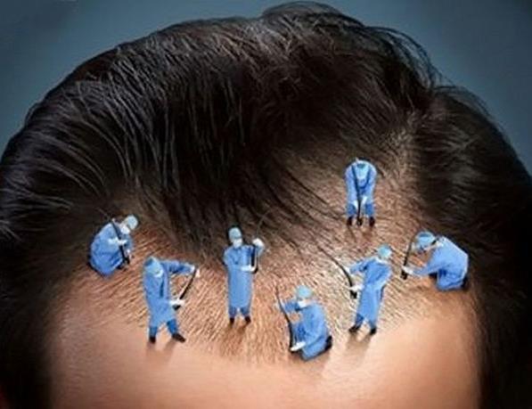 Navigating the Complexities of Hair Transplantation: Complications and Evidence-Based Management