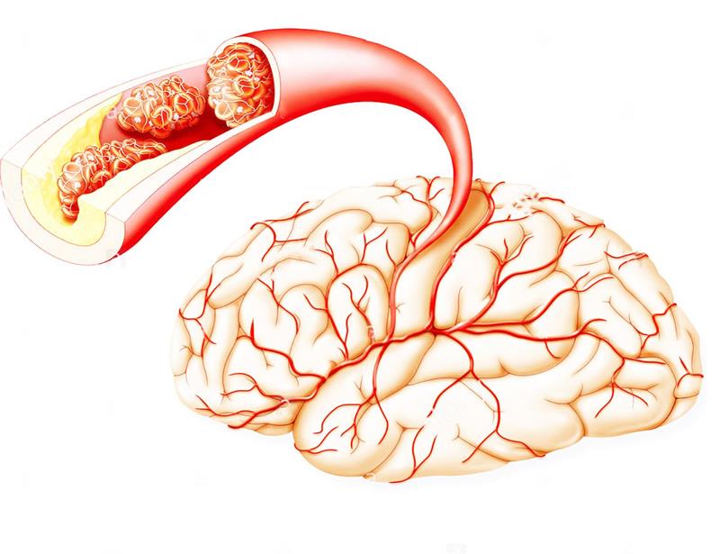 سکته مغزی چیست؟