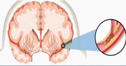 stroke