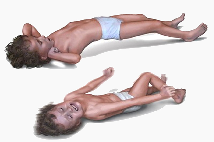 تشنج