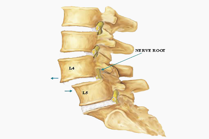 spondilolisthesis